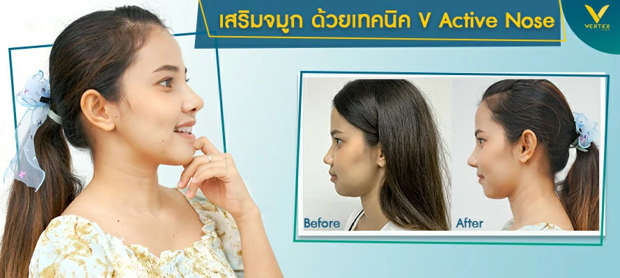 รีวิวเสริมจมูก
