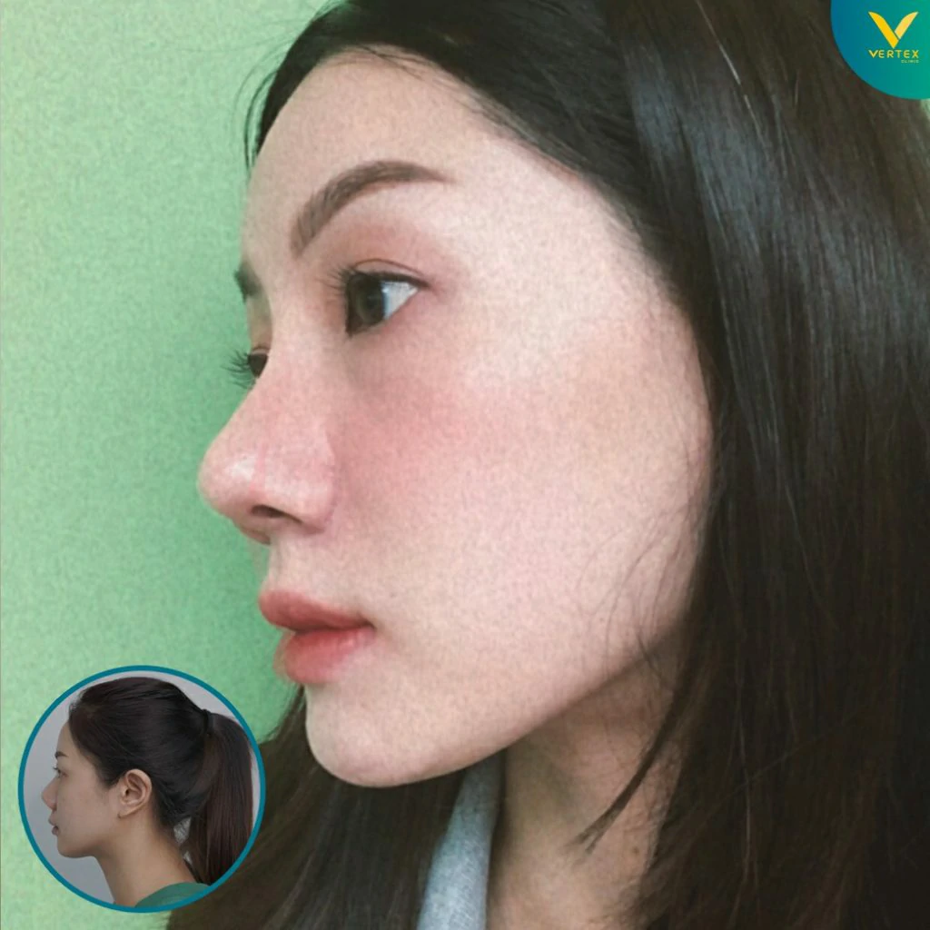 V-Active-Nose