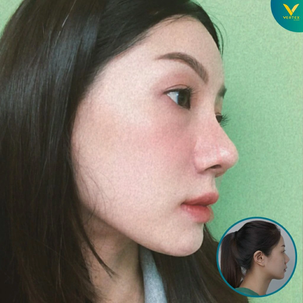 V-Active-Nose
