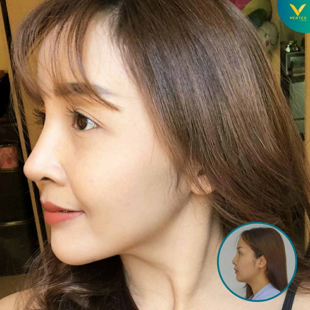 V-Active-Nose_Nuch