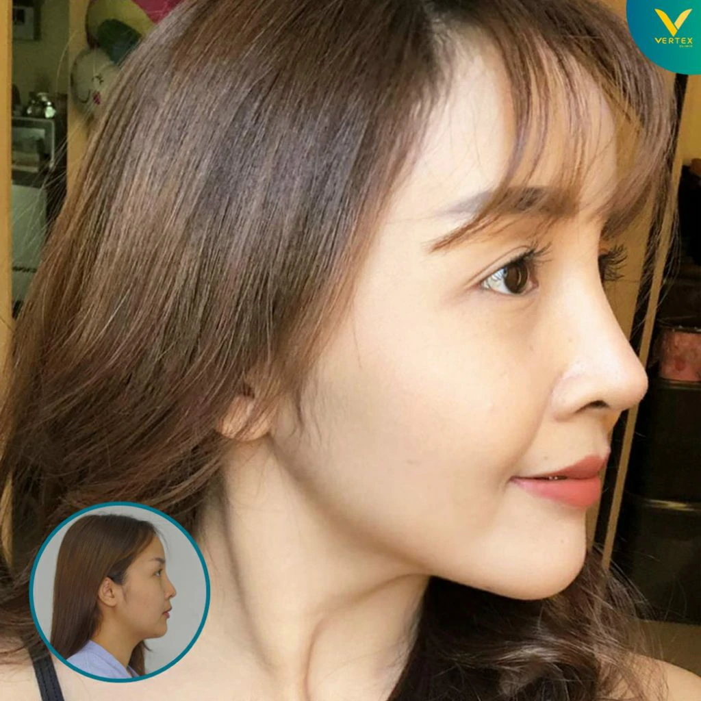 V-Active-Nose_Nuch