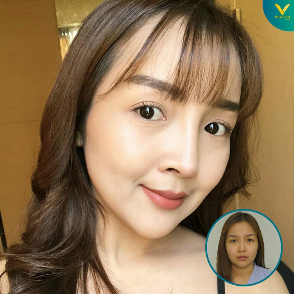 V-Active-Nose_Nuch