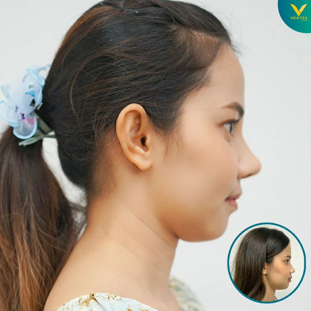V-Active-Nose