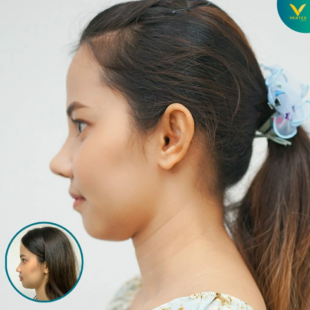 V-Active-Nose