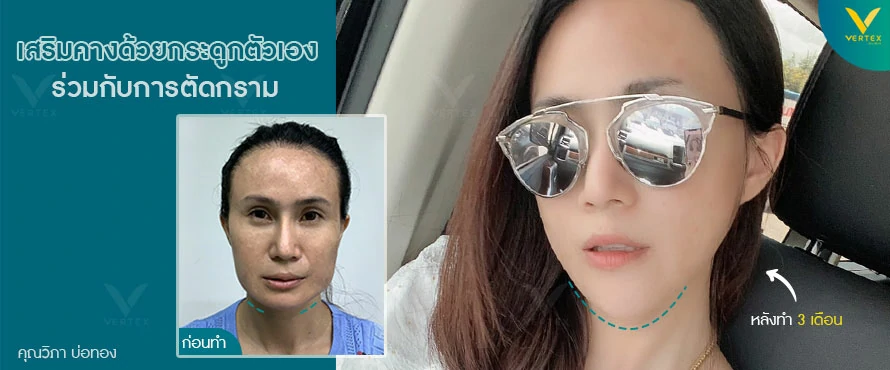 เสริมคางด้วยกระดูกตัวเอง
