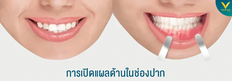 ตัดกรามในช่องปาก