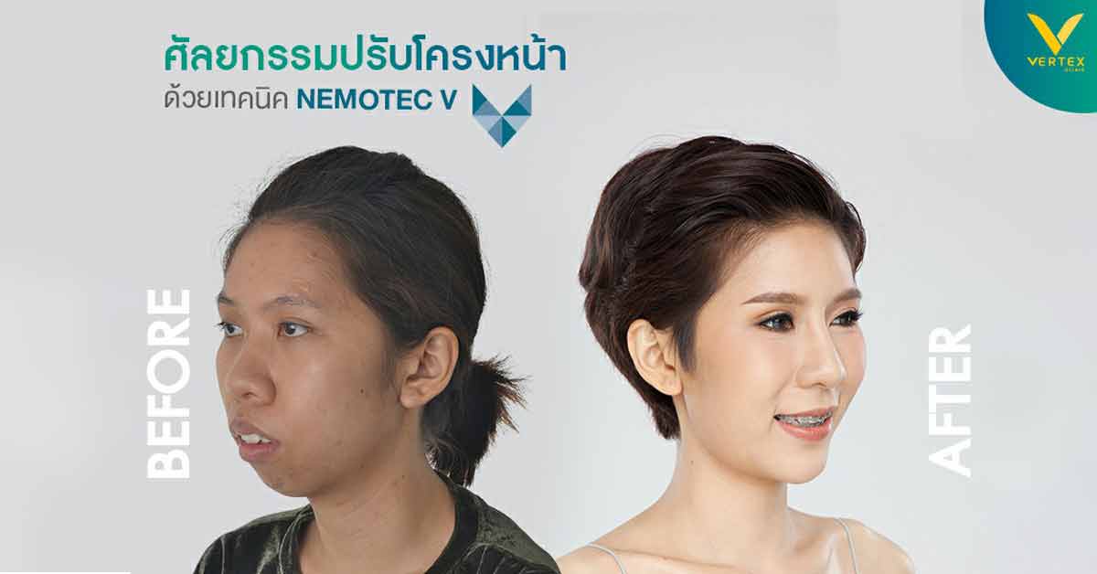 ศัลยกรรมปรับโครงหน้า