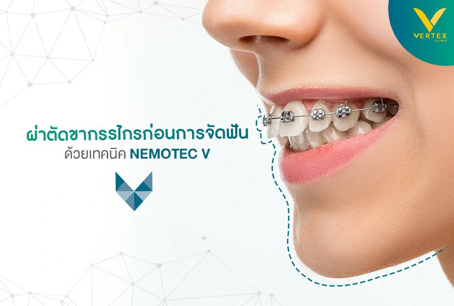ผ่าตัดขากรรไกรก่อนจัดฟัน