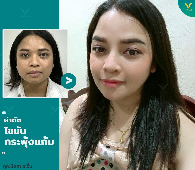 การผ่าตัดไขมันกระพุ้งแก้ม