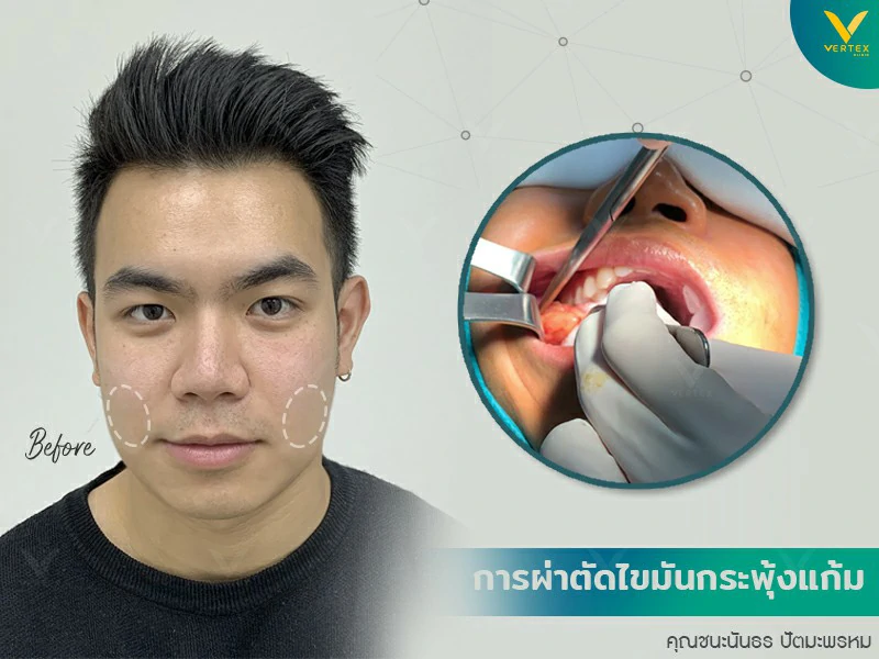 การผ่าตัดไขมันกระพุ้งแก้ม