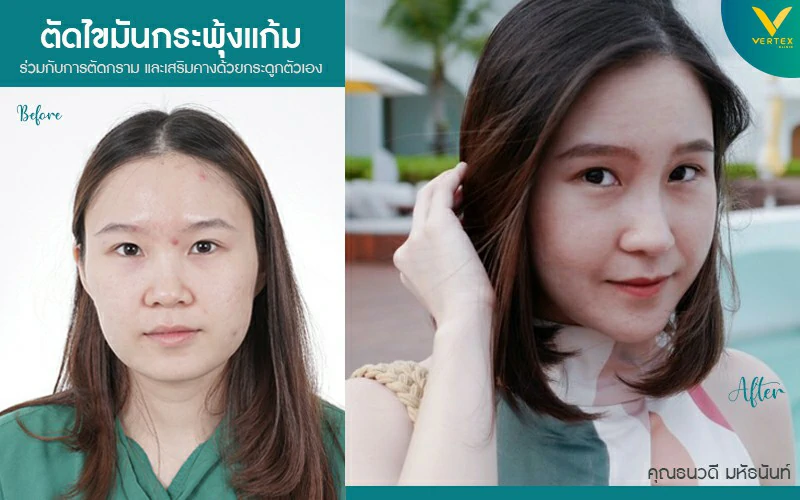 การผ่าตัดไขมันแก้ม