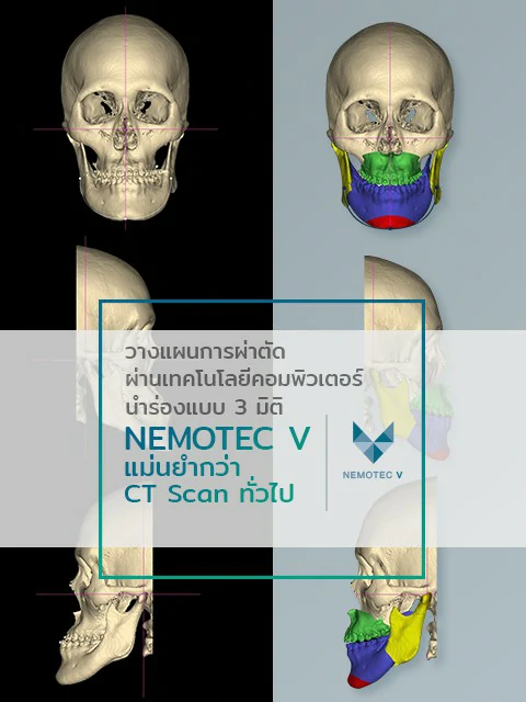 ผ่าตัดขากรรไกร-ศัลยกรรมผ่าตัดขากรรไกร