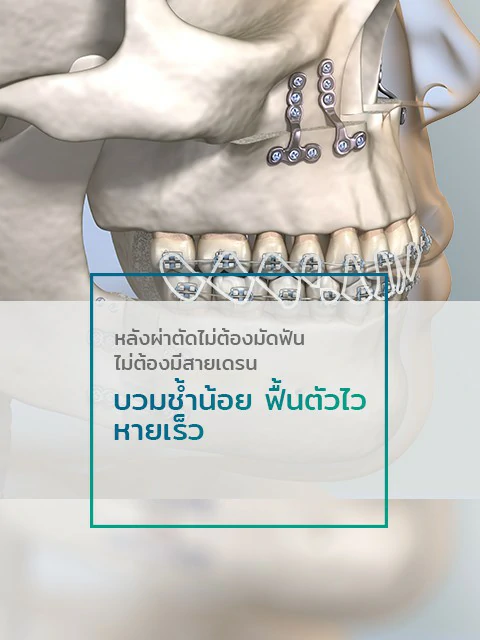 ผ่าตัดขากรรไกร-ศัลยกรรมผ่าตัดขากรรไกร