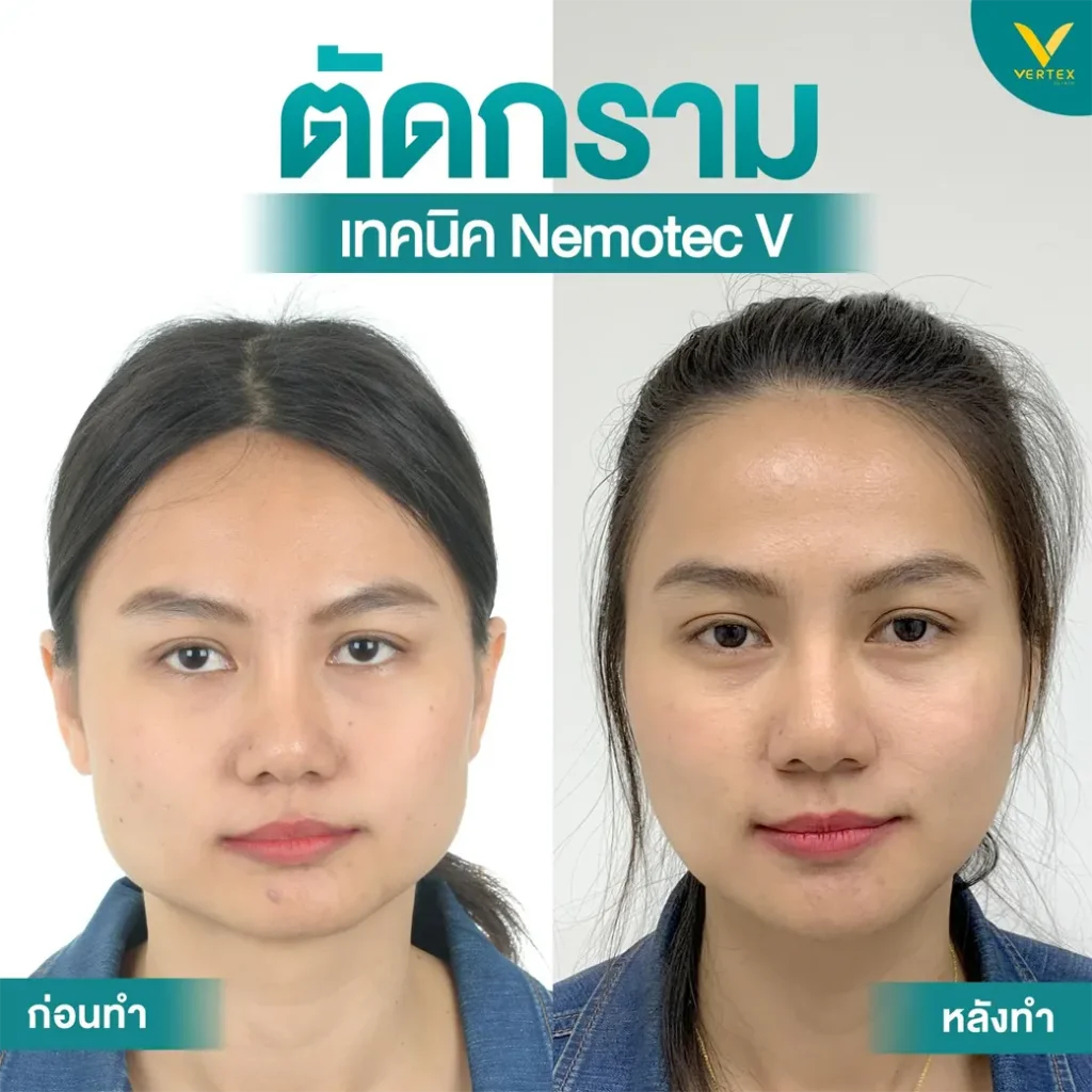 รีวิวตัดกราม