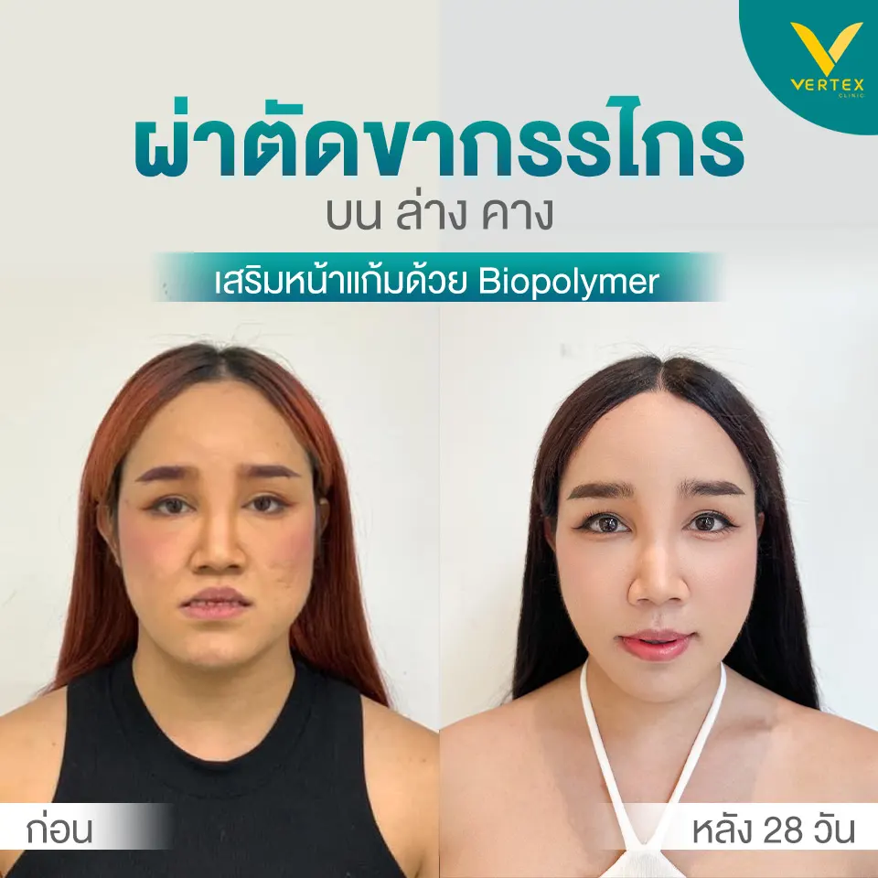 พุดเดิ้ล Before After