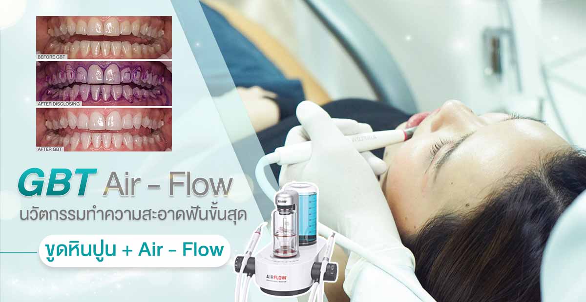 นวัตกรรมทำความสะอาดฟันขั้นสุด ขูดหินปูน กับ ร่วมกับการทำ air flow