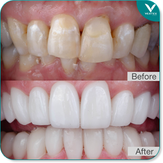 veneer
