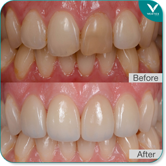 veneer