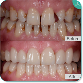 veneer