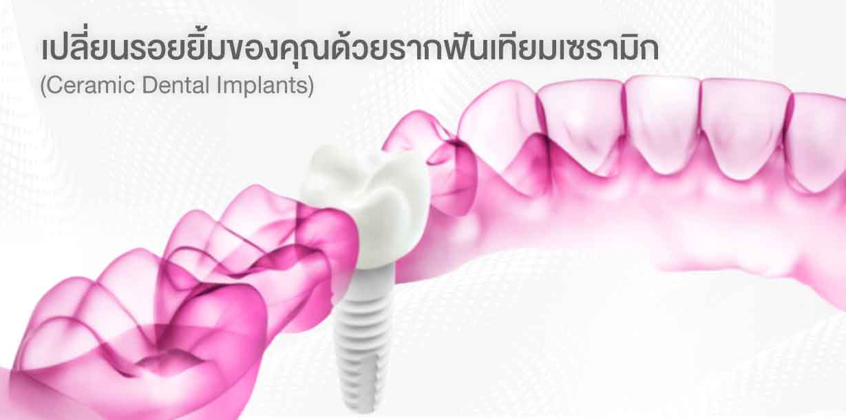รากฟันเทียมไร้เหล็ก
