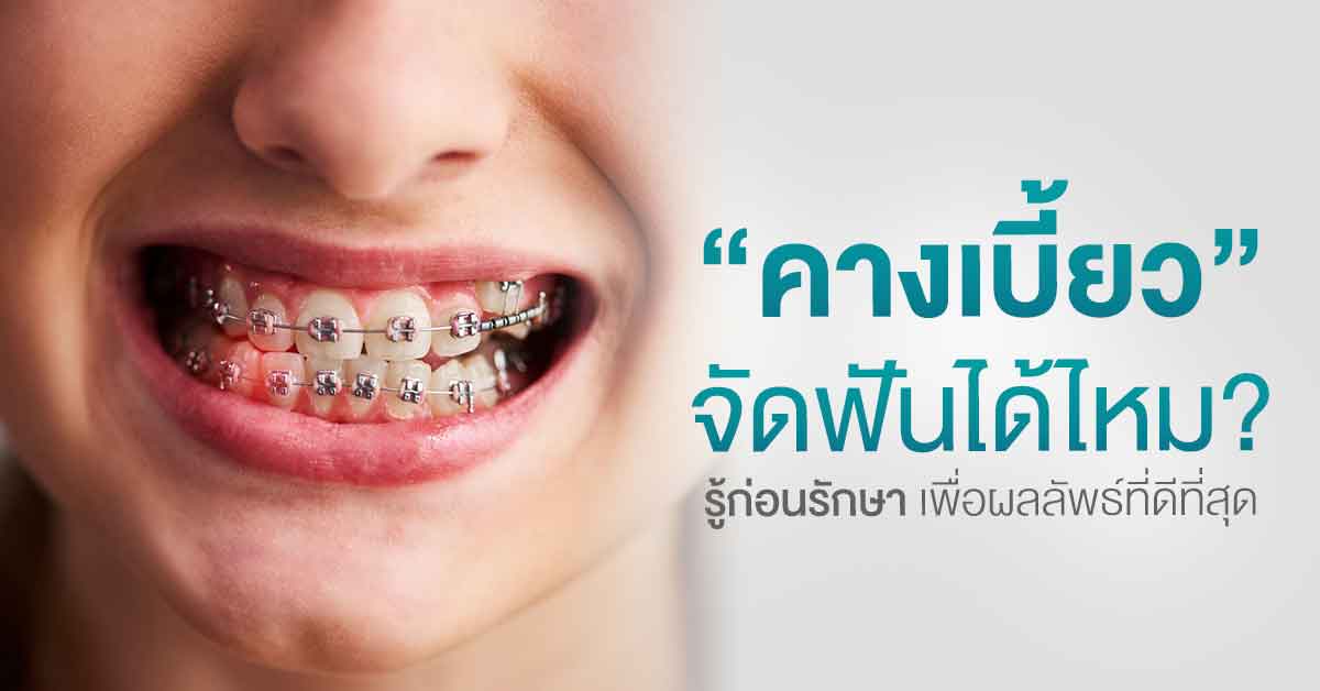 คางเบี้ยวจัดฟันได้ไหม