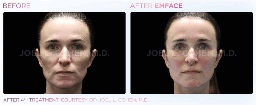 Emface
