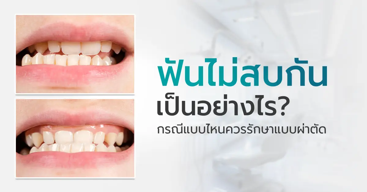 ฟันไม่สบกัน เป็นยังไง