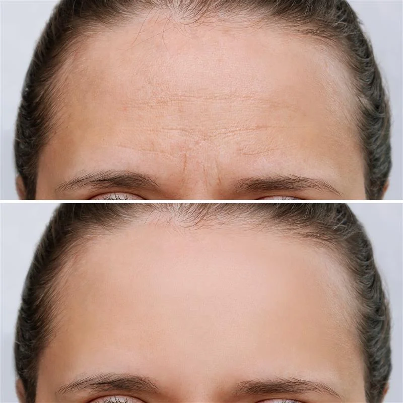 young-woman-with-wrinkles-forehead